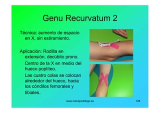 www.menapodologo.es 128
Genu Recurvatum 2
Técnica: aumento de espacio
en X, sin estiramiento.
Aplicación: Rodilla en
extensión, decúbito prono.
Centro de la X en medio del
hueco poplíteo.
Las cuatro colas se colocan
alrededor del hueco, hacia
los cóndilos femorales y
tibiales.
 
