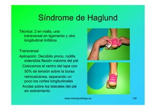 www.menapodologo.es 130
Síndrome de Haglund
Técnica: 2 en malla, una
transversal en ligamento y otra
longitudinal linfática
Transversal
Aplicación: Decúbito prono, rodilla
extendida flexión máxima del pié
Colocamos el centro del tape con
50% de tensión sobre la bursa
retrocalcánea, separando un
poco los cortes longitudinales
Anclas sobre los laterales del pié
sin estiramiento
 