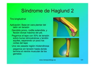 www.menapodologo.es 131
Síndrome de Haglund 2
Tira longitudinal
Aplicación: Base en cara plantar del
talón sin tensión
Decúbito prono, rodilla extendida, y
flexión dorsal máxima del pié.
Pegamos el tape con 50% de tensión
sobre bursa retrocalcánea y tendón
aquiles, separando un poco los
cortes del tape
Una vez pasada región miotendinosa
pegamos sin tensión hasta donde
termina el vientre muscular de los
gemelos
 