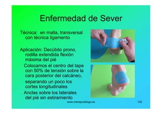 www.menapodologo.es 132
Enfermedad de Sever
Técnica: en malla, transversal
con técnica ligamento
Aplicación: Decúbito prono,
rodilla extendida flexión
máxima del pié
Colocamos el centro del tape
con 50% de tensión sobre la
cara posterior del calcáneo,
separando un poco los
cortes longitudinales
Anclas sobre los laterales
del pié sin estiramiento
 