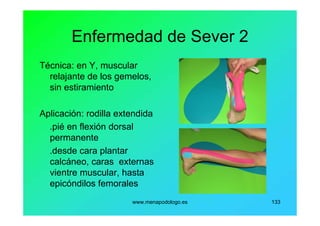 www.menapodologo.es 133
Enfermedad de Sever 2
Técnica: en Y, muscular
relajante de los gemelos,
sin estiramiento
Aplicación: rodilla extendida
.pié en flexión dorsal
permanente
.desde cara plantar
calcáneo, caras externas
vientre muscular, hasta
epicóndilos femorales
 
