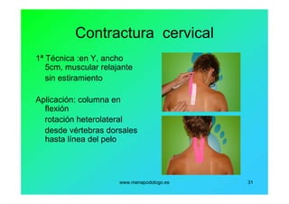 www.menapodologo.es 31
Contractura cervical
1ª Técnica :en Y, ancho
5cm, muscular relajante
sin estiramiento
Aplicación: columna en
flexión
rotación heterolateral
desde vértebras dorsales
hasta línea del pelo
 