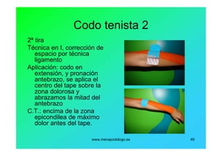 www.menapodologo.es 49
Codo tenista 2
2ª tira
Técnica en I, corrección de
espacio por técnica
ligamento
Aplicación: codo en
extensión, y pronación
antebrazo, se aplica el
centro del tape sobre la
zona dolorosa y
abrazamos la mitad del
antebrazo
C.T.: encima de la zona
epicondilea de máximo
dolor antes del tape.
 