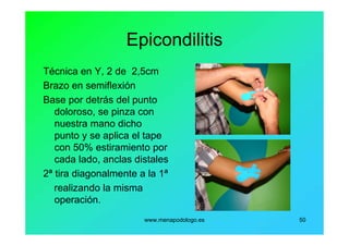 www.menapodologo.es 50
Epicondilitis
Técnica en Y, 2 de 2,5cm
Brazo en semiflexión
Base por detrás del punto
doloroso, se pinza con
nuestra mano dicho
punto y se aplica el tape
con 50% estiramiento por
cada lado, anclas distales
2ª tira diagonalmente a la 1ª
realizando la misma
operación.
 