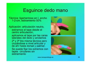 www.menapodologo.es 59
Esguince dedo mano
Técnica: ligamentosa en I, ancho
1-2-cm, estiramiento 50%
Aplicación: articulación neutra,
estiramos el tape desde el
centro articulación,
aplicamos el tape por las caras
laterales del dedo y anclamos
2ª y 3ª tira misma técnica pero
cruzándose a nivel articular y
de ahí hasta dorsal y palmar.
Se puede fijar los extremos con
tapes circulares sin
estiramiento
 