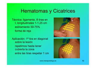 www.menapodologo.es 62
Hematomas y Cicatrices
Técnica: ligamento, 8 tiras en
I, longitudinales 1-1,25 cm
estiramiento 50-75%
forma de reja
Aplicación: 1ª tira en diagonal
sobre la lesión
repetimos hasta tener
cubierta la zona
entre las tiras respetar 1 cm
 