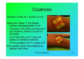 www.menapodologo.es 63
Cicatrices
Técnica: 3 tiras en I, ancho 2,5 cm.
Aplicación: Base 1ª tira lateral
cicatriz sobrepasándola 2 cm.
Tracción (10%-20%) en dirección
a la cicatriz y ancla 2 cm por el
otro lado.
La 2ª tira junto a la 1ª pero se
coloca en sentido contrario.
3ª tira paralela a la 1ª y junto a 2ª
Si la cicatriz tiene mas longitud se
aplican mas tiras.
 