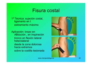 www.menapodologo.es 64
Fisura costal
1ª Técnica: sujeción costal,
ligamento en I
estiramiento máximo
Aplicación: brazo en
ABdución , en inspiración
tronco en flexión lateral
heterolateral
desde la zona dolorosa
hacia extremos
sobre la costilla lesionada
 