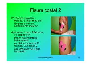 www.menapodologo.es 65
Fisura costal 2
2ª Técnica: sujeción
oblicua, 2 ligamento en I
longitud de15 cm,
estiramiento máximo
Aplicación. brazo ABdución,
en inspiración
tronco flexión lateral
heterolateral
en oblicuo sobre la 1ª
técnica, una antes y
otra después del lugar
lesionado
 