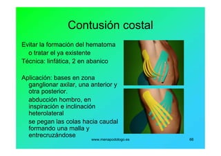 www.menapodologo.es 66
Contusión costal
Evitar la formación del hematoma
o tratar el ya existente
Técnica: linfática, 2 en abanico
Aplicación: bases en zona
ganglionar axilar, una anterior y
otra posterior.
abducción hombro, en
inspiración e inclinación
heterolateral
se pegan las colas hacia caudal
formando una malla y
entrecruzándose
 