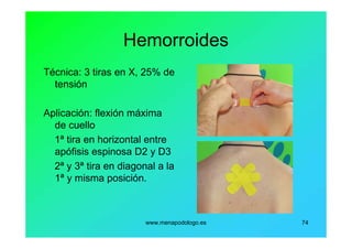www.menapodologo.es 74
Hemorroides
Técnica: 3 tiras en X, 25% de
tensión
Aplicación: flexión máxima
de cuello
1ª tira en horizontal entre
apófisis espinosa D2 y D3
2ª y 3ª tira en diagonal a la
1ª y misma posición.
 