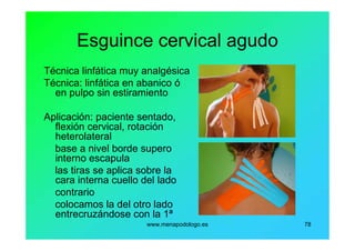 www.menapodologo.es 78
Esguince cervical agudo
Técnica linfática muy analgésica
Técnica: linfática en abanico ó
en pulpo sin estiramiento
Aplicación: paciente sentado,
flexión cervical, rotación
heterolateral
base a nivel borde supero
interno escapula
las tiras se aplica sobre la
cara interna cuello del lado
contrario
colocamos la del otro lado
entrecruzándose con la 1ª
 