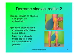 www.menapodologo.es 80
Derrame sinovial rodilla 2
Técnica: linfática en abanico
ó en pulpo, sin
estiramiento.
Aplicación: bipedestación,
extensión rodilla, flexión
dorsal del pié.
Base por encima del
hueco poplíteo, tiras
hacia caudal hasta
gemelos.
 
