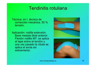 www.menapodologo.es 92
Tendinitis rotuliana
Técnica: en I, técnica de
corrección mecánica, 50 %
tensión.
Aplicación: rodilla extensión.
Base meseta tibial anterior.
Flexión rodilla 90º, se aplica
el tape sobre el tendón y
una vez pasado la rótula se
aplica el ancla sin
estiramiento.
 