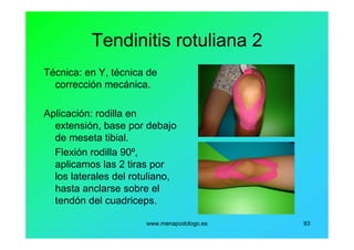 www.menapodologo.es 93
Tendinitis rotuliana 2
Técnica: en Y, técnica de
corrección mecánica.
Aplicación: rodilla en
extensión, base por debajo
de meseta tibial.
Flexión rodilla 90º,
aplicamos las 2 tiras por
los laterales del rotuliano,
hasta anclarse sobre el
tendón del cuadriceps.
 