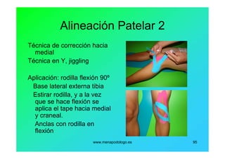 www.menapodologo.es 95
Alineación Patelar 2
Técnica de corrección hacia
medial
Técnica en Y, jiggling
Aplicación: rodilla flexión 90º
Base lateral externa tibia
Estirar rodilla, y a la vez
que se hace flexión se
aplica el tape hacia medial
y craneal.
Anclas con rodilla en
flexión
 