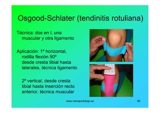 www.menapodologo.es 96
Osgood-Schlater (tendinitis rotuliana)
Técnica: dos en I, una
muscular y otra ligamento
Aplicación: 1ª horizontal,
rodilla flexión 90º
desde cresta tibial hasta
laterales, técnica ligamento
2ª vertical, desde cresta
tibial hasta inserción recto
anterior. técnica muscular
 