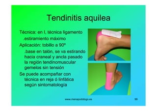 www.menapodologo.es 99
Tendinitis aquilea
Técnica: en I, técnica ligamento
.estiramiento máximo
Aplicación: tobillo a 90º
.base en talón, se va estirando
hacia craneal y ancla pasado
la región tendinomuscular
gemelos sin tensión
Se puede acompañar con
técnica en reja ó linfática
según sintomatología
 