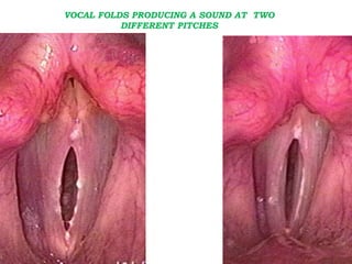VOCAL FOLDS PRODUCING A SOUND AT TWO
DIFFERENT PITCHES
 