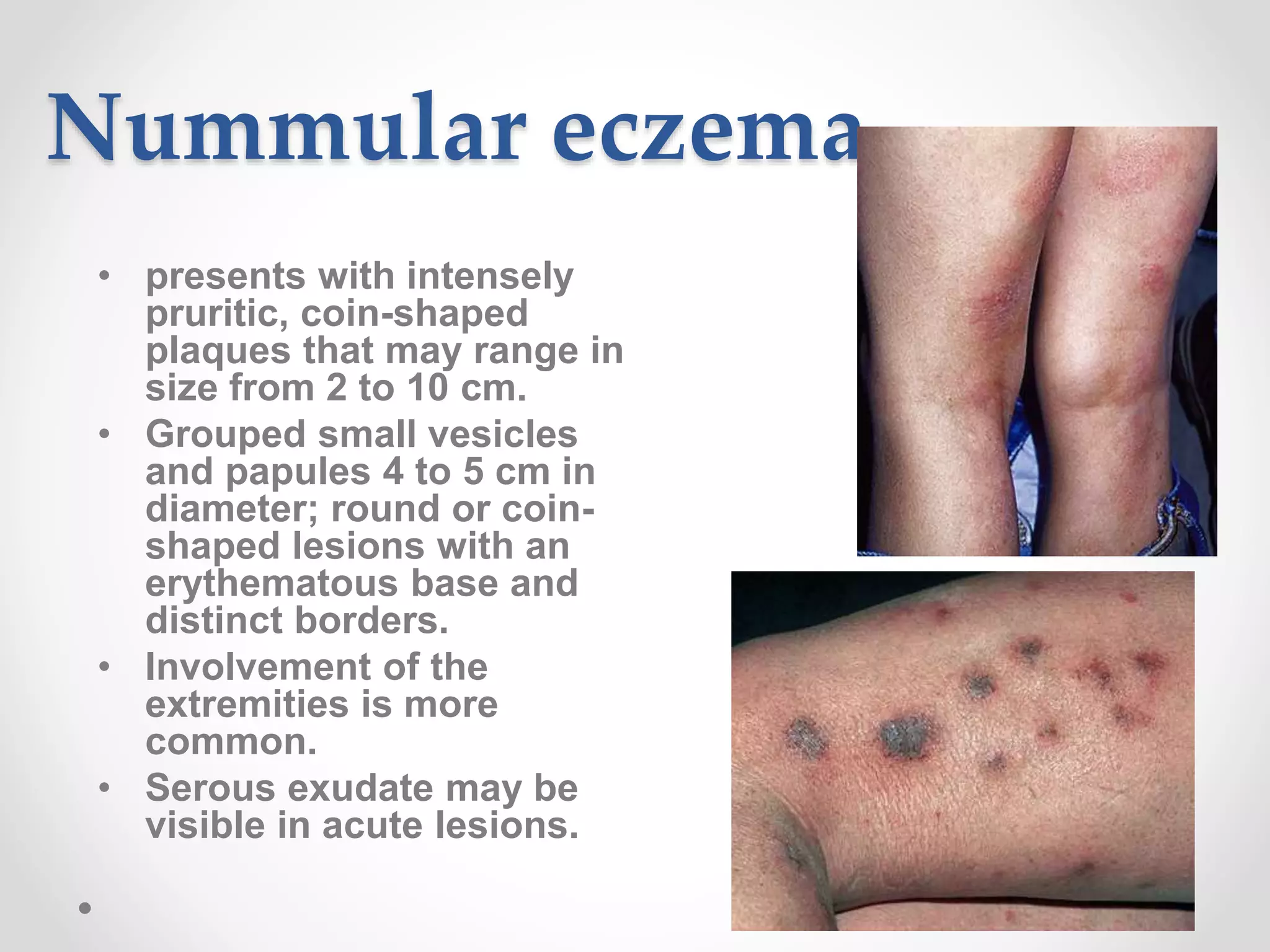 Pityriasis rosea | PPTX