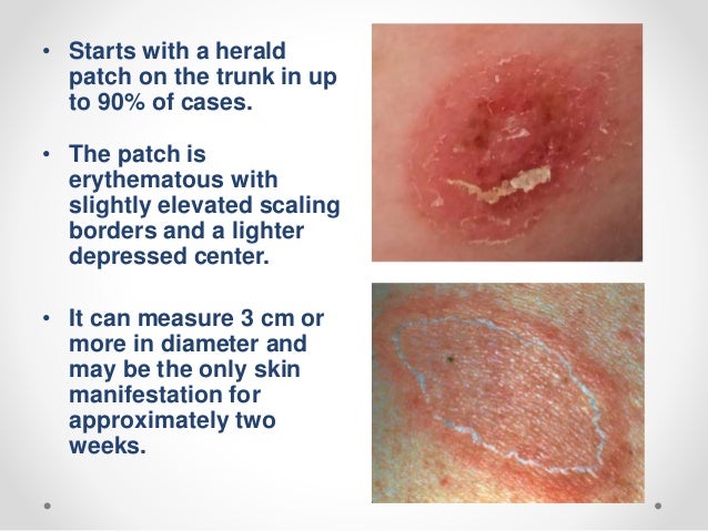 Pityriasis Rosea