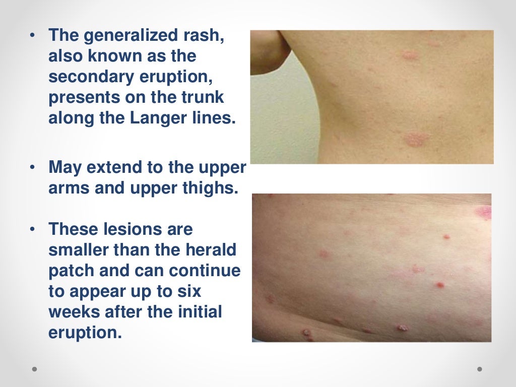 What Are The Stages Of Pityriasis Rosea New Health Advisor Images and