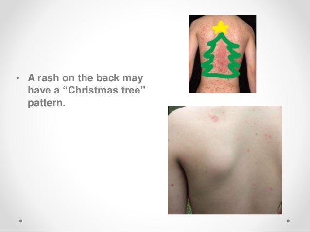 Pityriasis Rosea Pityriasis Rosea