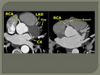 CT Coronary angiography | PPTX