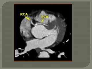 CT Coronary angiography | PPTX