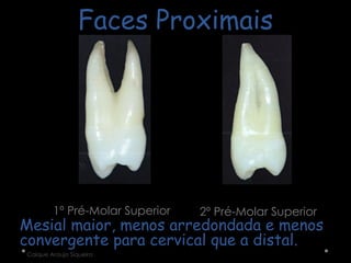 Faces Proximais
1º Pré-Molar Superior 2º Pré-Molar Superior
Mesial maior, menos arredondada e menos
convergente para cervical que a distal.
Caíque Araujo Siqueira
 
