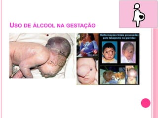 USO DE ÁLCOOL NA GESTAÇÃO
 