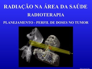 RADIOTERAPIA
RADIAÇÃO NA ÁREA DA SAÚDE
PLANEJAMENTO - PERFIL DE DOSES NO TUMOR
Walter Siqueira Paes
 