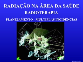 RADIOTERAPIA
RADIAÇÃO NA ÁREA DA SAÚDE
PLANEJAMENTO - MÚLTIPLAS INCIDÊNCIAS
Walter Siqueira Paes
 