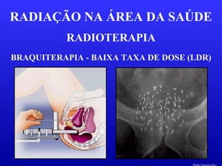RADIOTERAPIA
RADIAÇÃO NA ÁREA DA SAÚDE
BRAQUITERAPIA - BAIXA TAXA DE DOSE (LDR)
Walter Siqueira Paes
 
