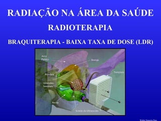 RADIOTERAPIA
RADIAÇÃO NA ÁREA DA SAÚDE
BRAQUITERAPIA - BAIXA TAXA DE DOSE (LDR)
Walter Siqueira Paes
 