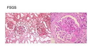 FSGS
 