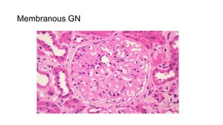 Membranous GN
 