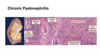 Chronic Pyelonephritis
 