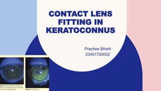 CONTACT LENS
FITTING IN
KERATOCONNUS
Prachee Bharti
23401720032
 