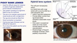 PIGGY BANK LENSES 6
• Used for difficult cases for instance
in cases of rgp lens intolerance,
proud nebula in keratoconus
...