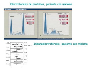 Electroforesis de proteínas, paciente con mieloma Inmunoelectroforesis, paciente con mieloma 