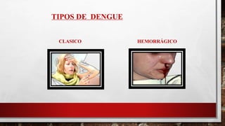 TIPOS DE DENGUE
CLASICO HEMORRÁGICO