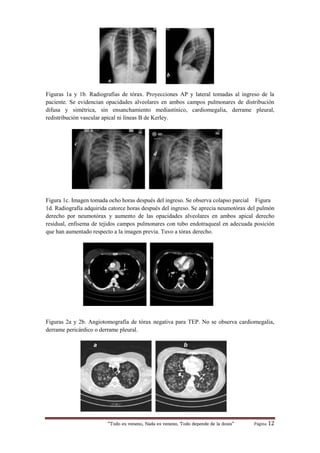 “Todo es veneno, Nada es veneno, Todo depende de la dosis“ Página 12
Figuras 1a y 1b. Radiografías de tórax. Proyecciones AP y lateral tomadas al ingreso de la
paciente. Se evidencian opacidades alveolares en ambos campos pulmonares de distribución
difusa y simétrica, sin ensanchamiento mediastínico, cardiomegalia, derrame pleural,
redistribución vascular apical ni líneas B de Kerley.
c
d
Figura 1c. Imagen tomada ocho horas después del ingreso. Se observa colapso parcial Figura
1d. Radiografía adquirida catorce horas después del ingreso. Se aprecia neumotórax del pulmón
derecho por neumotórax y aumento de las opacidades alveolares en ambos apical derecho
residual, enfisema de tejidos campos pulmonares con tubo endotraqueal en adecuada posición
que han aumentado respecto a la imagen previa. Tuvo a tórax derecho.
Figuras 2a y 2b. Angiotomografía de tórax negativa para TEP. No se observa cardiomegalia,
derrame pericárdico o derrame pleural.
a b
a
b
 