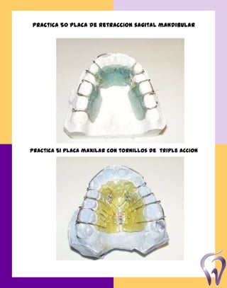 Practica 50 placa de retraccion sagital mandibular
Practica 51 placa maxilar con tornillos de triple accion
 