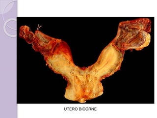 UTERO BICORNE 
 