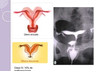 Útero arcuato 
Clase IV. 10% de 
malformaciones 
 