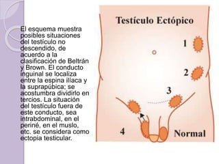  El esquema muestra 
posibles situaciones 
del testículo no 
descendido, de 
acuerdo a la 
clasificación de Beltrán 
y Brown. El conducto 
inguinal se localiza 
entre la espina ilíaca y 
la suprapúbica; se 
acostumbra dividirlo en 
tercios. La situación 
del testículo fuera de 
este conducto, sea 
intrabdominal, en el 
periné, en el muslo, 
etc. se considera como 
ectopia testicular. 
 