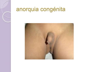 anorquia congénita 
 