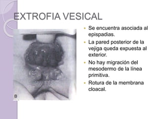 EXTROFIA VESICAL 
 Se encuentra asociada al 
epispadias. 
 La pared posterior de la 
vejiga queda expuesta al 
exterior. 
 No hay migración del 
mesodermo de la línea 
primitiva. 
 Rotura de la membrana 
cloacal. 
 