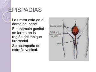 EPISPADIAS 
 La uretra esta en el 
dorso del pene. 
 El tubérculo genital 
se formo en la 
región del tabique 
urorrectal. 
 Se acompaña de 
extrofia vesical. 
 